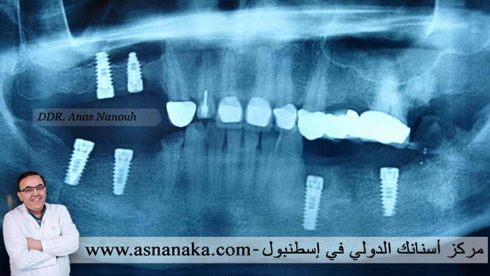 زراعة أربع زرعات في كلا الفكين 