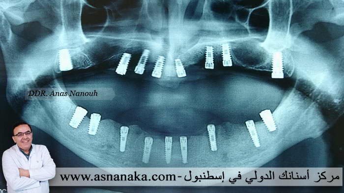 زراعه الأسنان في كلا الفكين وقد تم زياده عدد الزرعات في الفك السفلي بسبب قصر الزراعات و بسبب الامتصاص العظمي الشديد 