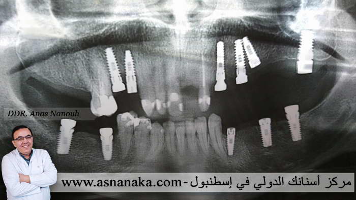 صوره شعاعية بانورامية لزرعات الأسنان في كلى الفكين للمراجع الفلسطيني في أسطنبول 