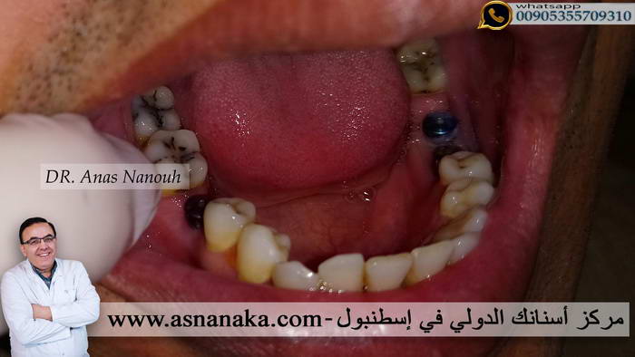 صوره لزرعات الأسنان بعد ان تم زراعتهم بدون شق جراحي وبدون اي آلم في خلال ربع ساعه