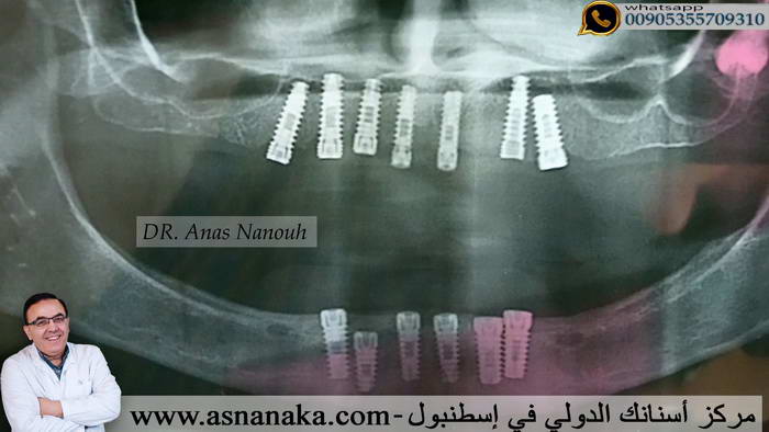 زراعة ستة زرعات المانية في كل فك  