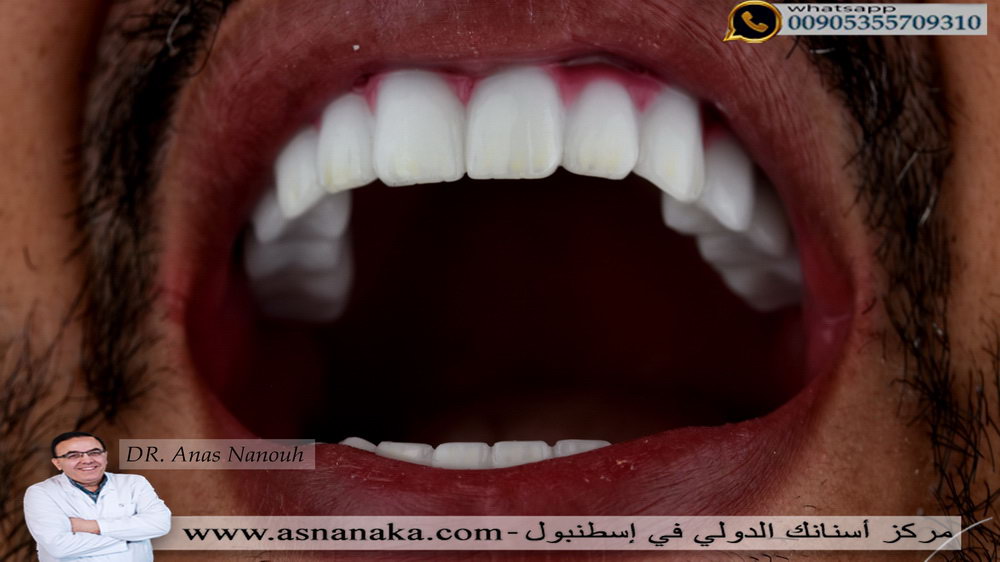 أبتسامة هوليود بعد الأنتهاء من تركيب الأسنان فوق الزرعات 