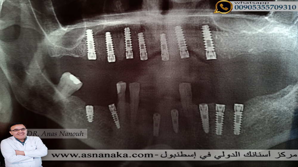 زراعة كامل الفكين لمراجعة عراقيات تعيش في امريكا