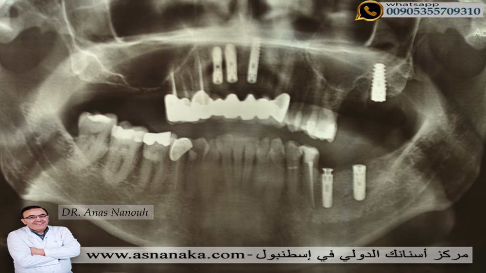 زراعه أربع زرعات في الفك العلوي وزرعتين في الفك السفلي لمراجعة عماني