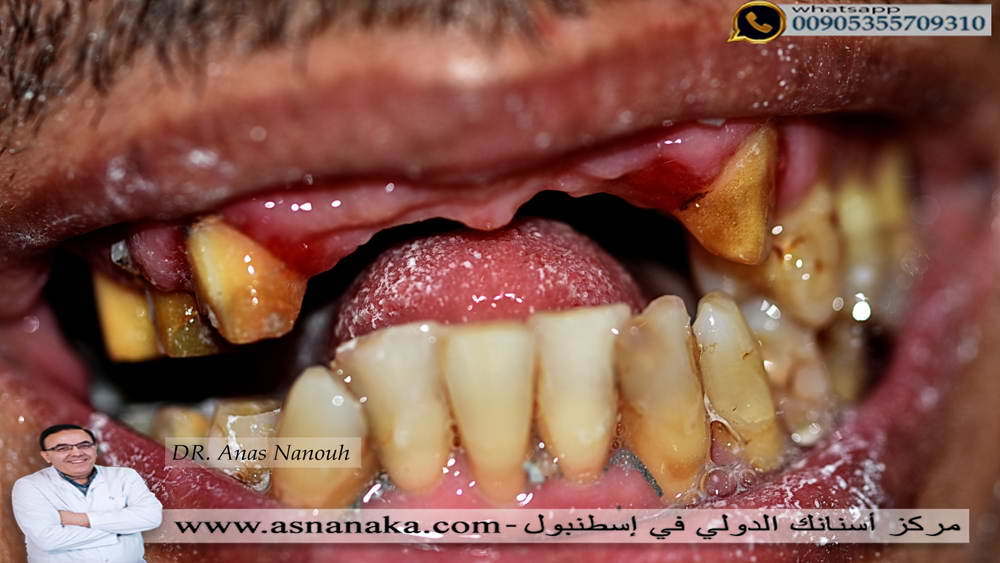 اسنان المراجع قبل البدء بالعلاج