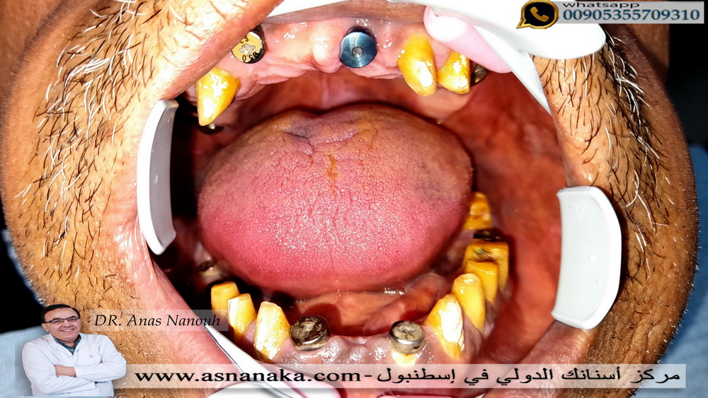 تشكيل اللثه حول الزراعات التي زرعت في كلا الفكين عن طريق وضع مشكلات اللثه