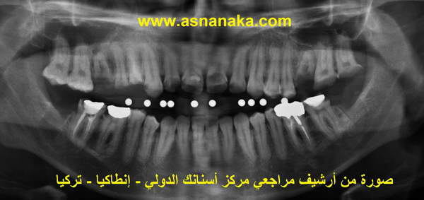 صوره شعاعية للأسنان واضح تماما كيف يوجد تباعد بين الفك السفلي والعلوي و التقاء الاسنان فقط في منطقه الأرحاء 