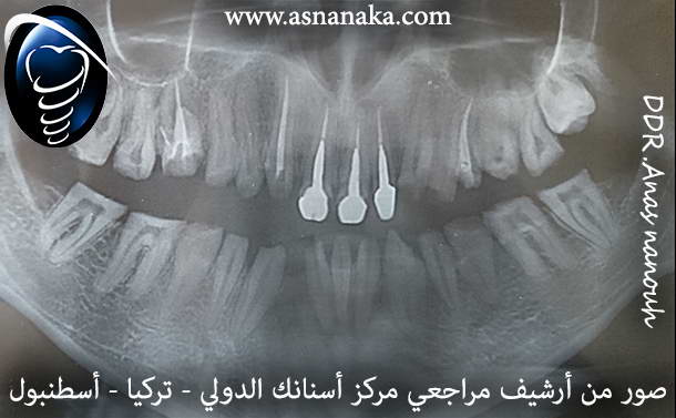 صوره شعاعيه للأسنان ويظهر فيها الأسنان وقت علاها النخر والتسوس والتهدم