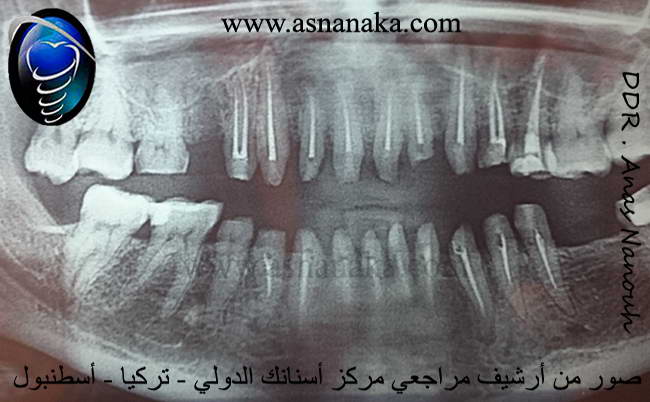 صوره لاسنان المراجعه بانوراميه توضح كيف ان هذا الدكتور المعالج قام بسحب اعصاب لجميع الاسنان وهذا غلط كان يجب ان لا يقوم فيه حتى لا تتموت الاسنان 