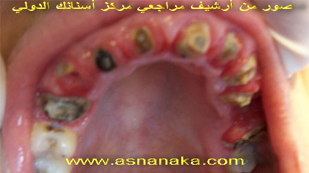 صورة أسنان متهدمة بشكل كامل وكيف تم علاجها