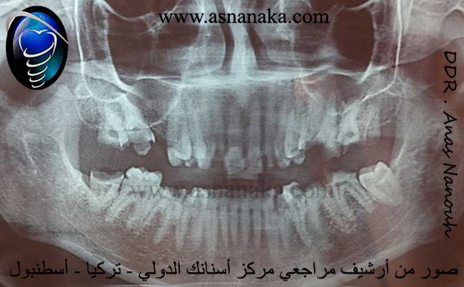 صوره شعاعيه للمراجع قبل البدء بالعلاج لاحظ معي كيف ان جذور الأسنان سليمه جدا ولا يوجد فيها التهابات فقط الاسنان متأكلة ومتسوسة