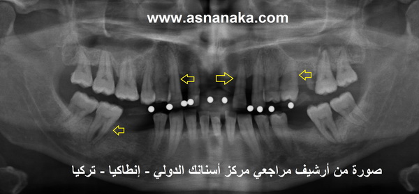 صورة شعاعية بانورامية للأسنان لاحظ معي مستوى العظم المتبقي بعد تراجع الأسنان