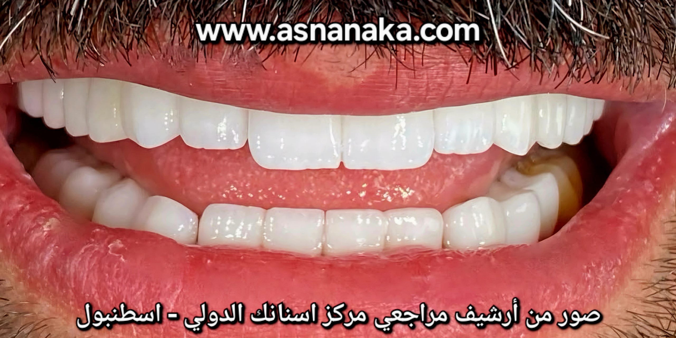 استاذ المراجعه بعد ان انتهينا من تركيب الاسنان فوق الدعامات التي هي موصوله بالزرعات