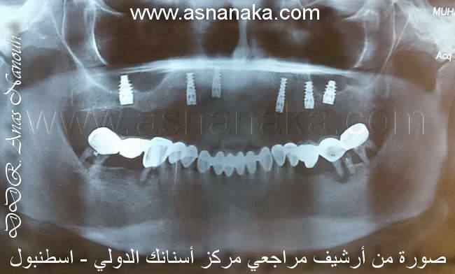 صوره شعاعيه بانوراميه للفكين قبل البدء بعلاج اسنانه وزراعه الاسنان في مركزنا الستة زرعات الموجوده هي قام بزراعتها في مركز اخر