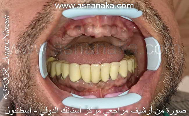 صورة لفم المراجع قبل البدء بالعلاج