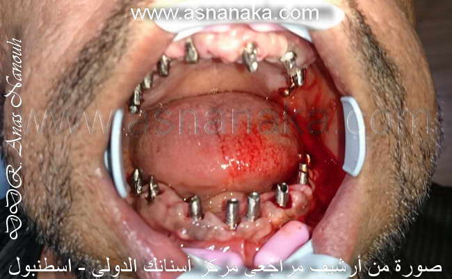 صوره زراعه الاسنان بعد ان تم تركيب الابوتمنت او الدعامات فوق الزرعات في كلا الفكين