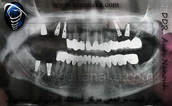 الصوره شعاعية بانوراميه للفكين ويظهر فيها الزراعات في كلا الفكين