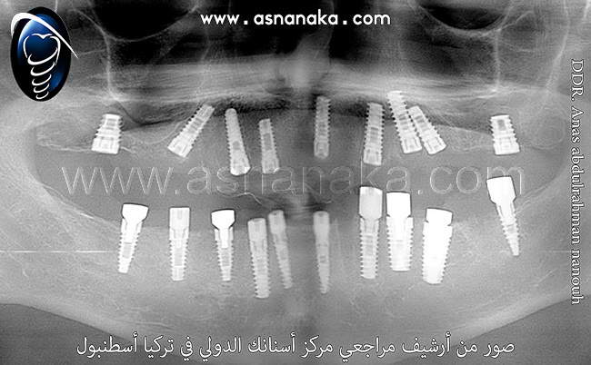 صورة شعاعية لزرعات الأسنان في كلا الفكين