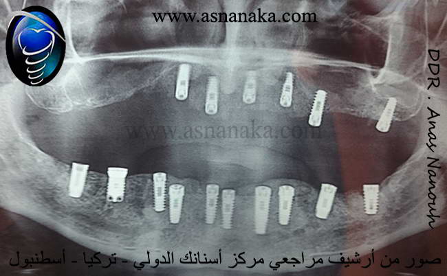 صورة شعاعية لزرعات الأسنان في كلا الفكين