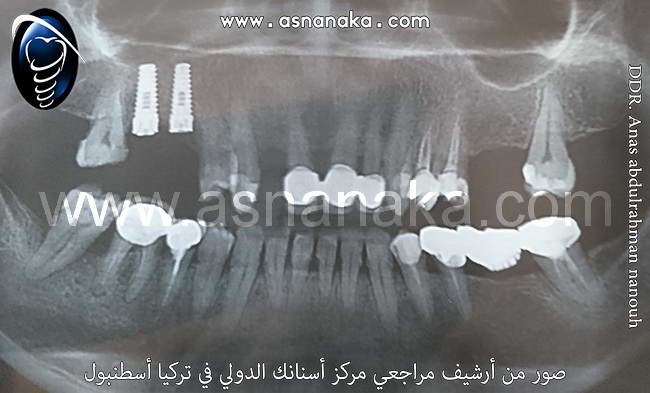 زراعه زراعتين المانيتين في الفك العلوي