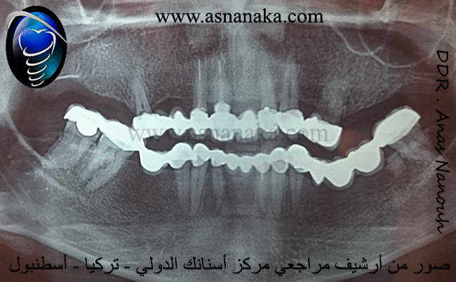 صورة شعاعية لأسنان المراجع في كلا الفكين لاحظ كيف أن تركيبات الأسنان الخلفية والأسنان الخلفية في الفك السفلي أعلى من الأسنان الأمامية وكيف أن الأسنان في الفك السفلي متشابكة مع الأسنان الفك العلوي ، هذا التشابك الأطباقي الغير طبيعي يؤدي إلى ضغط المفصل الفكي الصدغي بأتجاه الخلف ( خارج اللقمة )