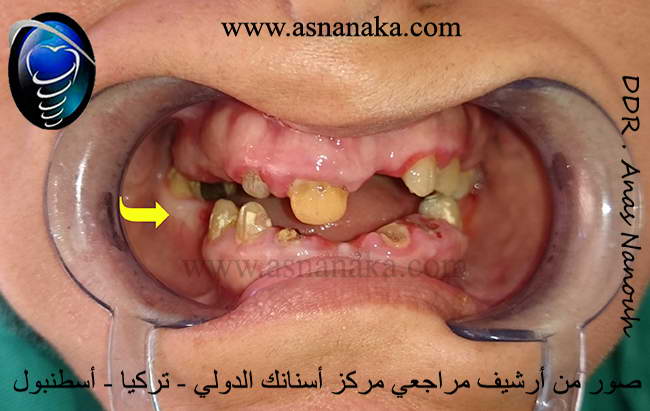 السهم يؤشر على الفجوة