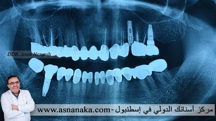 صوره شعاعيه بانوراميه بزرعات الاسنان بعد مضي اربع سنين من زراعتها ومن تركيب الاسنان الزركونيه فوقها