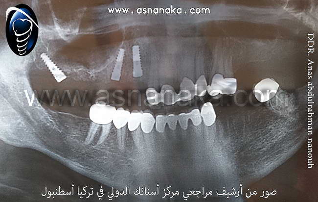 صوره شعاعيه لزراعه الثلاثه وقد تم تجاوز الجيب الفكي في الفك العلوي حتى لا نضطر الى زراعه العظم