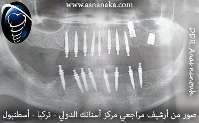 صورة شعاعية أولية قبل البدئ بالعلاج