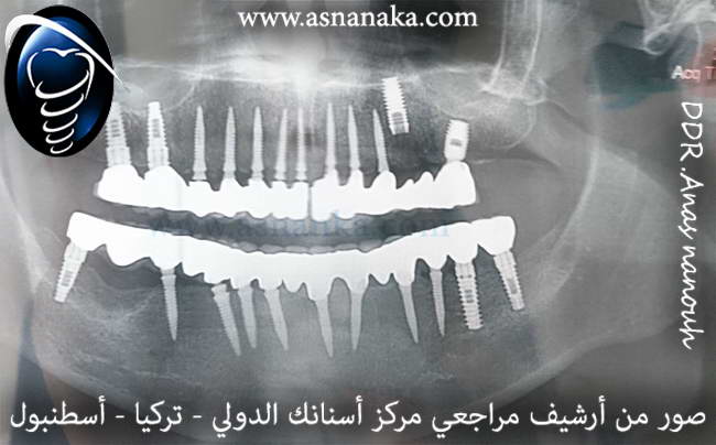 صورة شعاعية بانورامية بعد زراعة الخمسة زرعات إضافية في مركزنا وتركيب التركيبات فوق الزرعات لاحظ كيف تم تجاوز أحد الزرعات بسبب بعدها عن اللثة والتي تمت زراعتها في الأردن