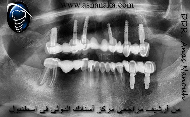 زراعات الاسنان في كلى الفكين كما تظهر في الصوره الشعاعيه البنوراميه والتي تم زراعتها في مصر