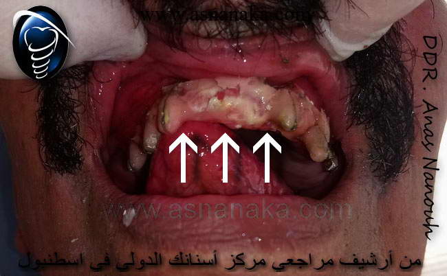 بعد نزع الجسور شاهد كمية المادة اللاصقة السامة التي سببت للمراجع حروق والتهابات في اللثة