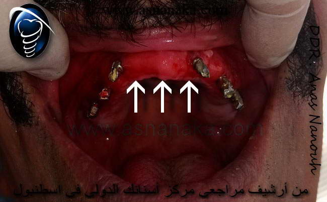 صورة للثة بعد نزع المادة اللاصقة التي سببت حروق والتهابات في اللثة شاهد لونها الدموي والذي يدل على تأكل في اللثة نتيجة لسموم الموجودة في المادة اللاصقة