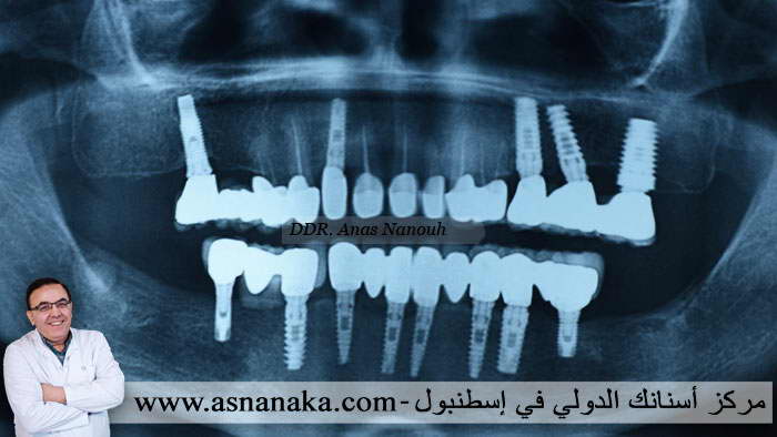 صوره شعاعيه لزراعات الاسنان بعد مضيء اربع سنين من زراعتها