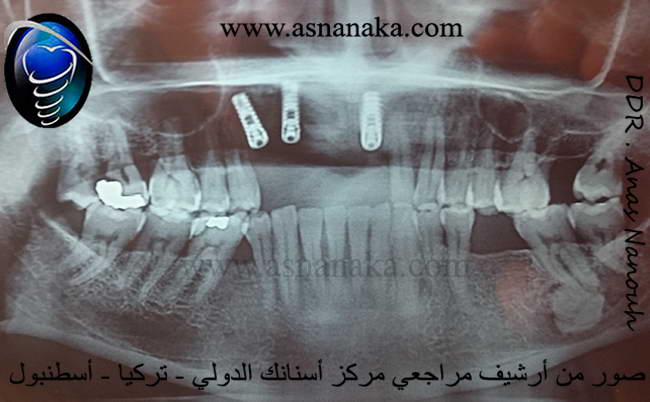 صورة شعاعية بانورامية لزرعات الأسنان الثلاثه في منطقه القواطع الاماميه العلويه