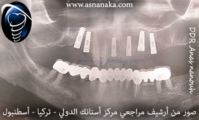 زراعه ستة زرعات في الفك العلوي  المانيه من شركه ريتر