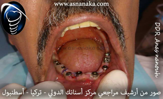 زراعه عشر زرعات فورية في الفك السفلي وتركيب وشكيلات اللثه فوقها