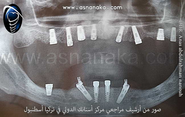 تمكنا من زراعه ست زراعات في الفك العلوي مع الاسف لما تمكن الا من زراعه زراعه واحده في الفك السفلي