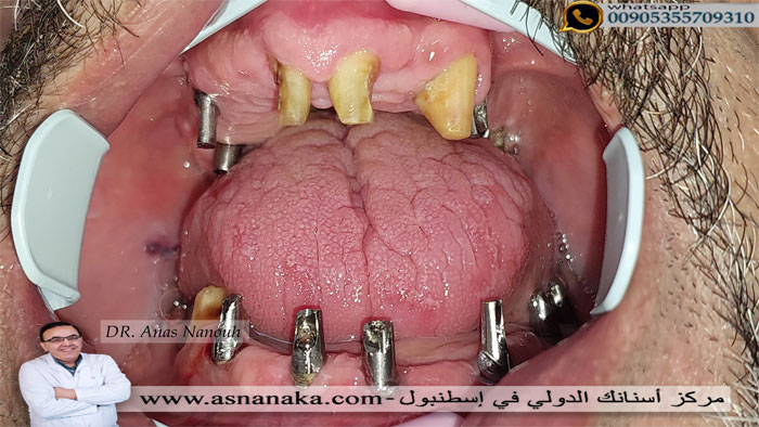 تركيب الدعامات فوق الزرعات الألمانية 