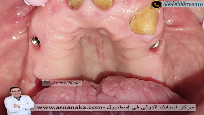 زرعات الأسنان الألمانية كما تبدوا في الفك العلوي