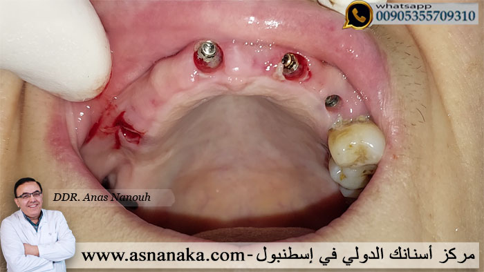 الزرعات التركية الأقتصادية كما تبدوا في الفك العلوي