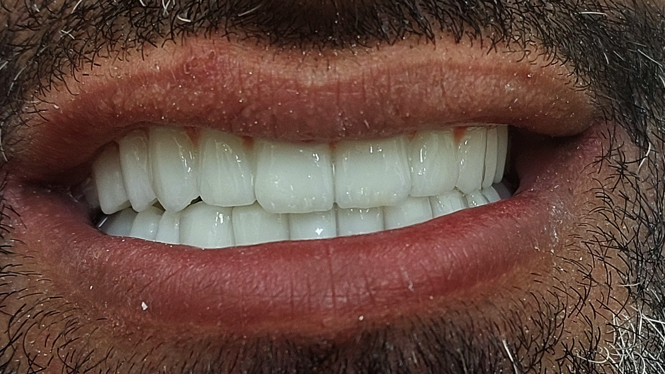 حالة لزرعات الأسنان TBR لا تسبب التهابات لثة ولا رائحة فم