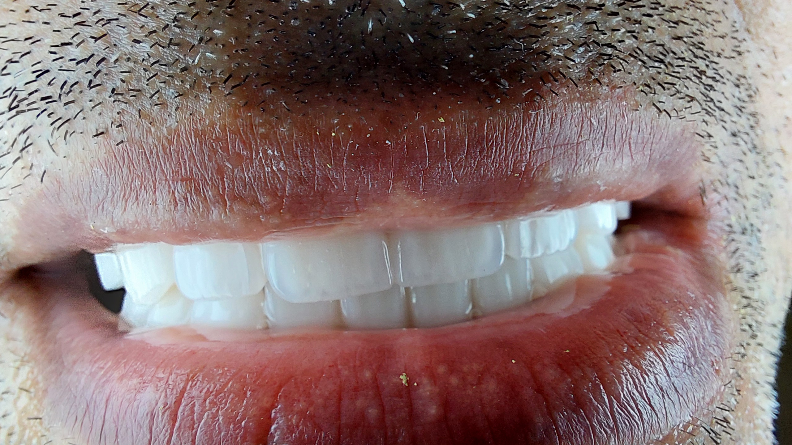 زراعة الأسنان لمراجع مغربي في اسطنبول وفيلم عن تجرببته