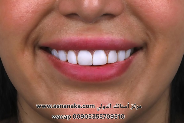 تركيبات كومبوزيت بيضاء غير متقنة