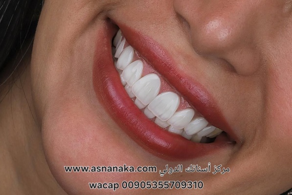 تركيبات زيركون لمراجعة مغربية في مركز أسنانك الدولي 