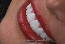 تركيبات زيركون لمراجعة مغربية فيىمركز أسنانك الدولي