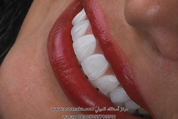 تركيبات زيركون لمراجعة مغربية فيىمركز أسنانك الدولي