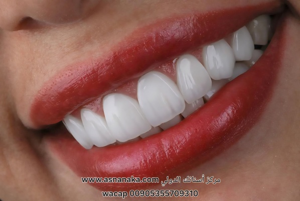 تركيبات زيركون لمراجعة مغربية في مركز أسنانك الدولي 