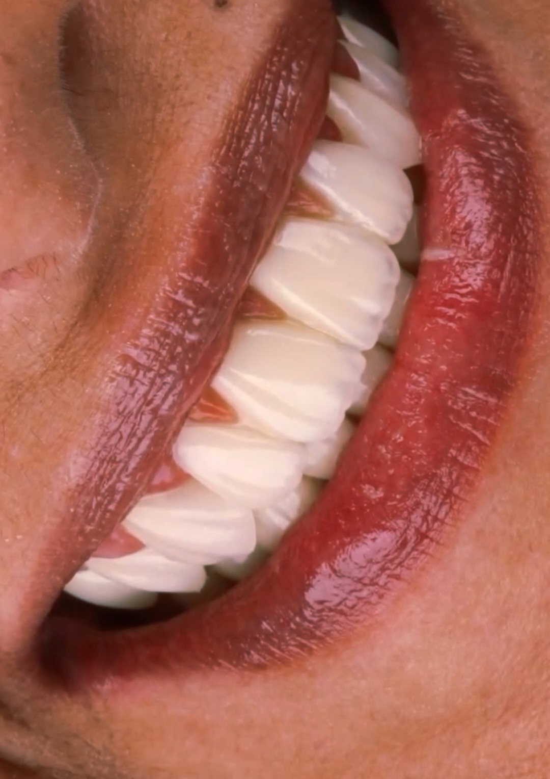 فيلم لابتسامة هوليود تم تركيبها في مركز أسنانك الدولي في أسطنبول